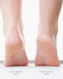 Bos Medicare Electric Foot Callus Remover